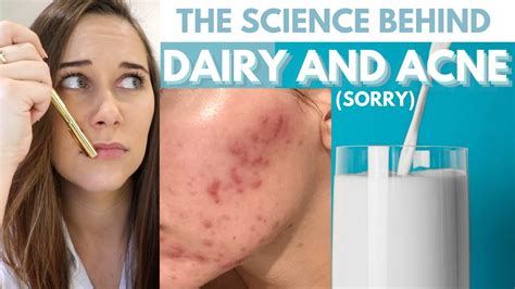 What Causes Acne From Dairy